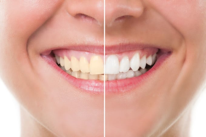 before and after teeth whitening photo, lady smiling
