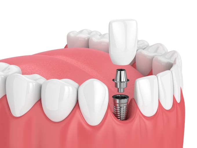 dental implant diagram